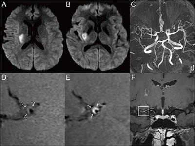 Wall characteristics of atherosclerotic middle cerebral arteries in patients with single or multiple infarcts: A high-resolution MRI Study